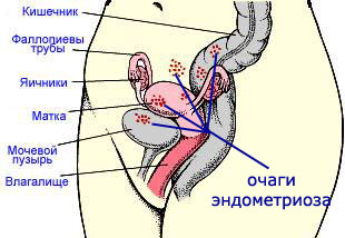 Endometrióza: léčba lidovými léky