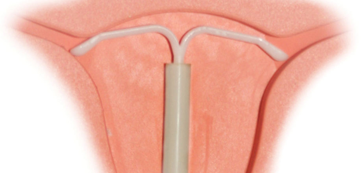 Je možné umístit intrauterinní pomůcku pro nuliparous ženy