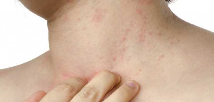 Co způsobuje vyrážku na krku: hlavní příčiny a metody léčby